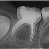 Milchbackenzahn mit Wurzelfüllung